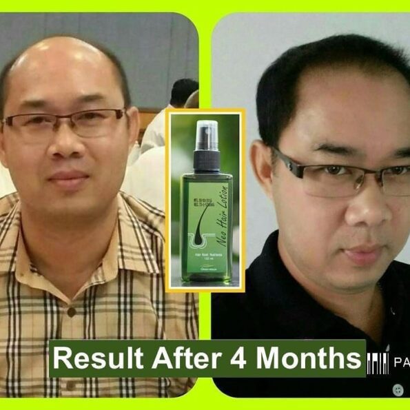 Before and after result after 4 months applying Neo Hair Lotion Hair Root Nutrients Spray 120ml | Thai Beauty Products NZ