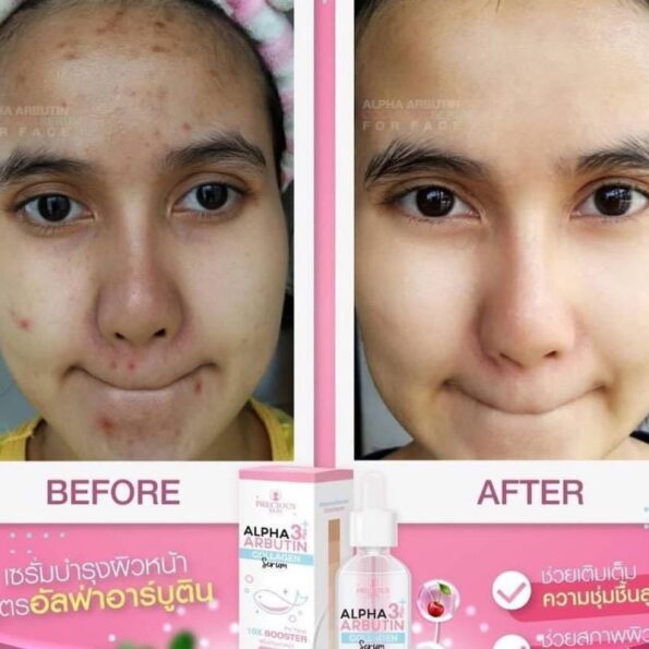 The before and after result of Precious Skin Alpha Arbutin 3+ Collagen Serum, for face 10X booster 50ml | Thai Beauty Products NZ