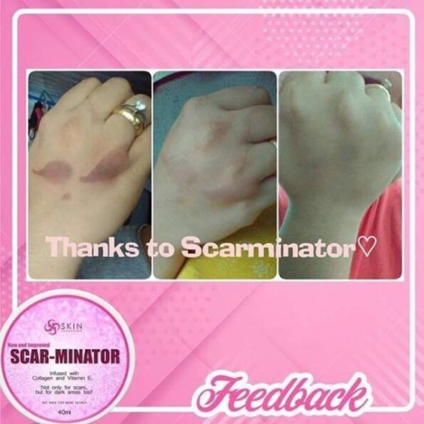 Before & after result of Skin sensation Scar-Minator, infused with collagen & vit e. Not only for scars, but for dark areas too | Filipino Skin Care Shop Nz