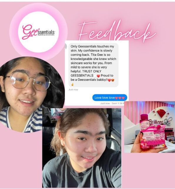 Customer's feedback, before and after photo for using Brilliant Skin Essentials Rejuvenating Set Upsize Bundle (Kojic Acid Soap, Rejuvenating Facial Toner, Rejuvenating Facial Cream & Sunblock Gel-Cream) | Filipino Beauty Products NZ