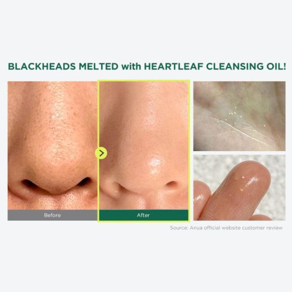 Before & after result of using Anua Heartleaf Pore Control Cleansing Oil 200ml | Korean Beauty Products NZ