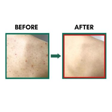 Before & after result of SOME BY MI Miracle Acne Clear Body Cleanser 400g | Korean Beauty Products NZ