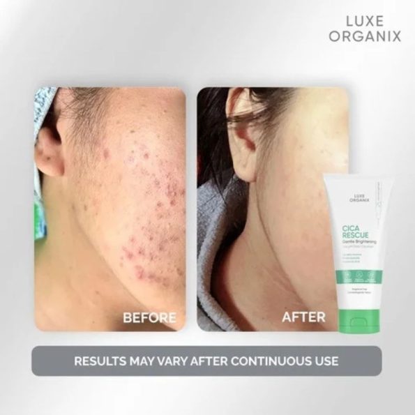 Before & after - Luxe Organix Cica Rescue Gentle Brightening Cleanser | Filipino Beauty Products NZ, Shop Filipino Beauty Brands NZ, Filipino Skin Care Shop Nz