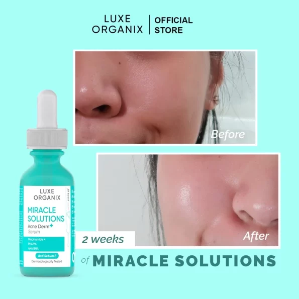 Before and after results after 2 weeks of using Luxe Organix Miracle Solutions Acne Derm+Serum | Filipino Skin Care Shop Nz