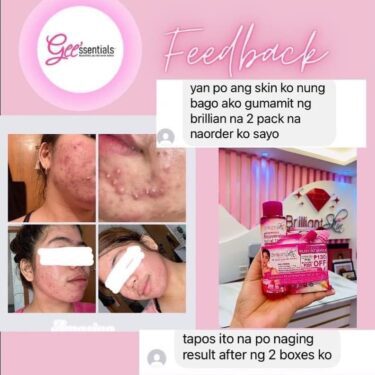 Customer's feedback, before and after photo for using Brilliant Skin Essentials Rejuvenating Set Upsize Bundle (Kojic Acid Soap, Rejuvenating Facial Toner, Rejuvenating Facial Cream & Sunblock Gel-Cream) | Filipino Beauty Products NZ