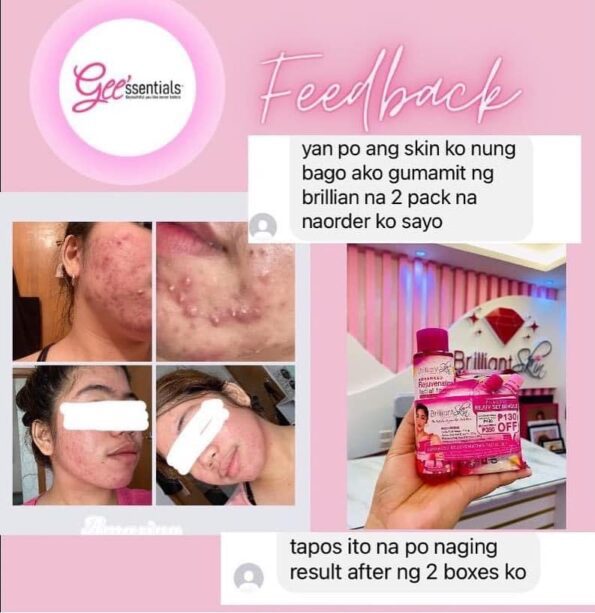 Customer's feedback, before and after photo for using Brilliant Skin Essentials Rejuvenating Set Upsize Bundle (Kojic Acid Soap, Rejuvenating Facial Toner, Rejuvenating Facial Cream & Sunblock Gel-Cream) | Filipino Beauty Products NZ