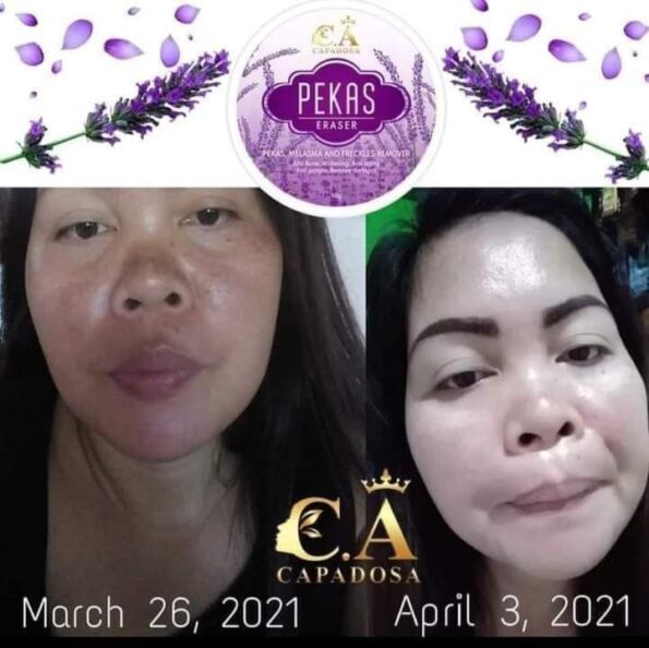 Customer shows her before & after result after she used Capadosa Pekas (Skin Pigmentation) Eraser - pekas, melasma, & freckles remover | Filipino Beauty Products NZ