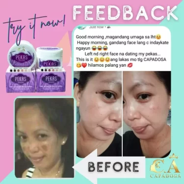 Review from a customer of Capadosa Pekas (Skin Pigmentation) Eraser - pekas, melasma, & freckles remover | Filipino Beauty Products NZ