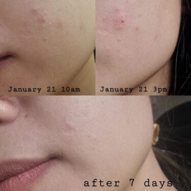 Before and after result of Perfected Aqua Depuff Low PH Mild Gel Cleanser available in 100ml | Filipino Skin Care Shop Nz