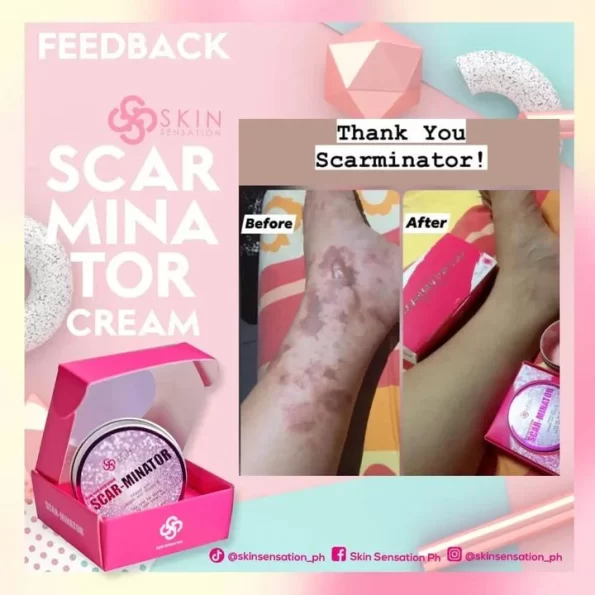 Result of Skin sensation Scar-Minator, infused with collagen & vit e. Not only for scars, but for dark areas too | Filipino Skin Care Shop Nz