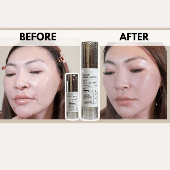 Before & after result of VT Cosmetics Reedle Shot 300 | Korean Beauty Products NZ