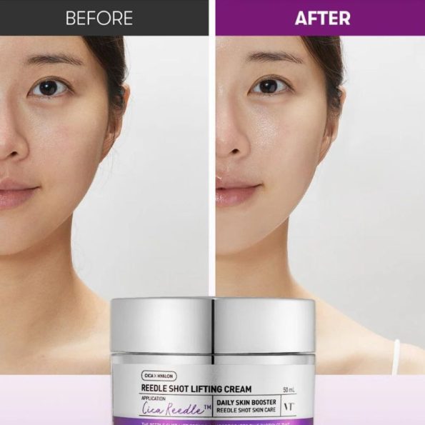 Before & After - VT Cosmetics Reedle Shot Lifting Cream | Korean Beauty Products NZ