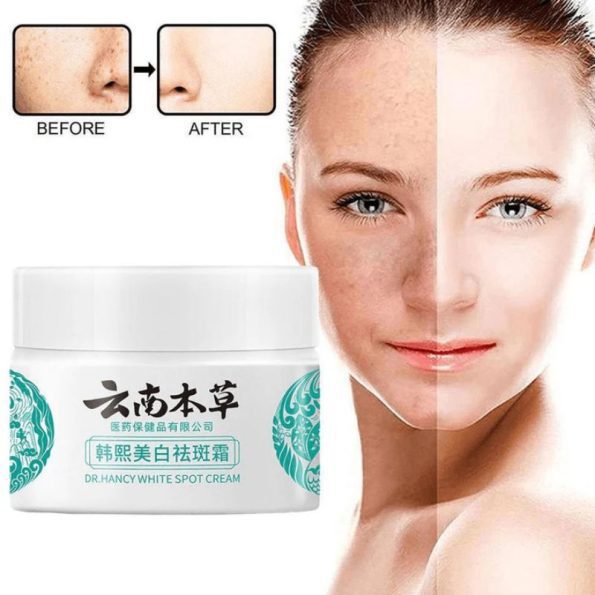 Before & after result of Dr. Hancy White Spot Cream | Japanese Beauty Products NZ