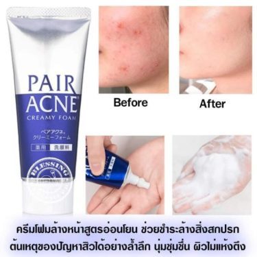 Before & after result of Lion Pair Acne Creamy Foam | Japanese Beauty Products NZ