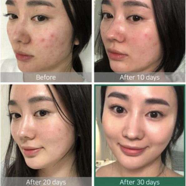 Result-SOME BY MI AHA BHA PHA 30 Days Miracle Toner | Korean Beauty Products NZ