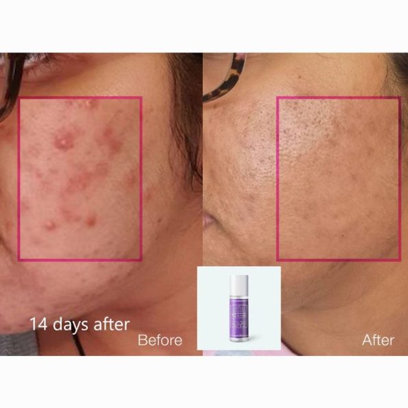 Before & after-Cos De BAHA Salicylic Acid BHA 2% Liquid | Korean Beauty Products NZ